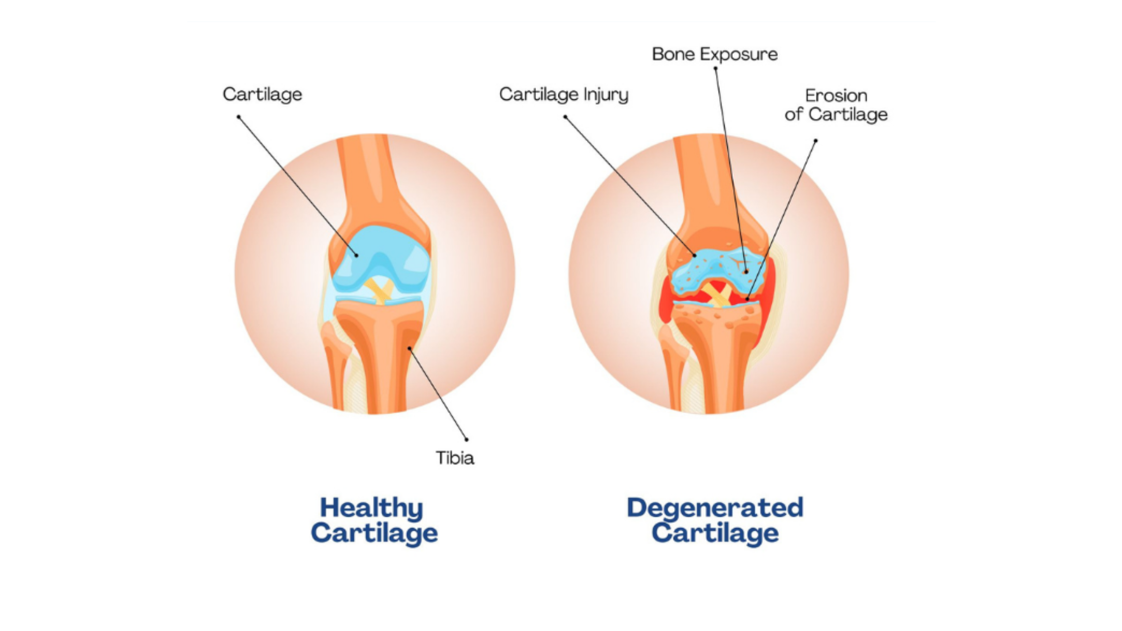 Healthy cartilage vs. degenerated cartilage